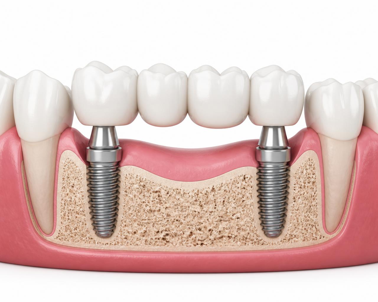 Illustration of an implant bridge replacing four missing lower teeth, anchored on two titanium implants integrated into the jawbone at either end of the span