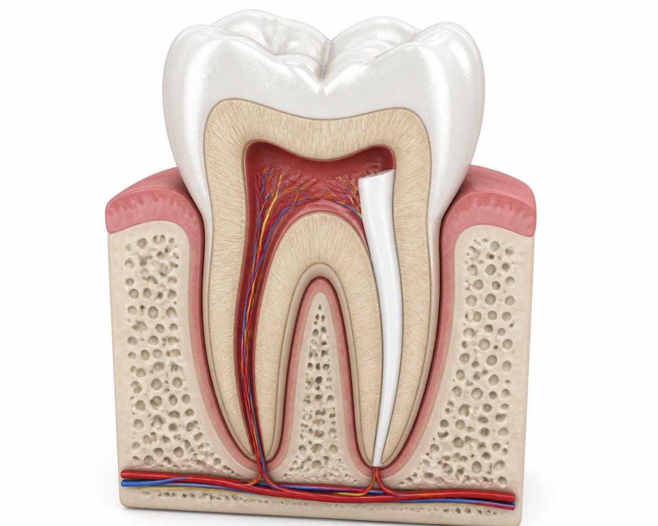 Cross-section illustration of a molar tooth showing enamel, dentin, and the red pulp chamber with nerves and blood vessels running into the roots, one canal cleaned and filled with white sealing material
