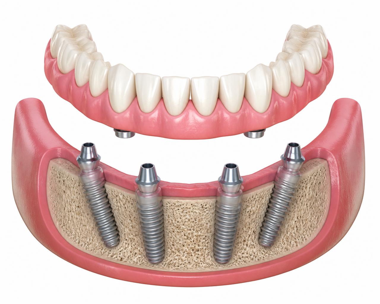 Illustration of a fixed full-arch bridge positioned above four angled dental implants anchored in the lower jaw